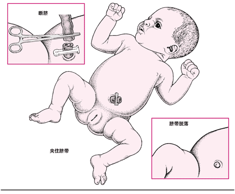 断脐过程（断脐步骤）-图1