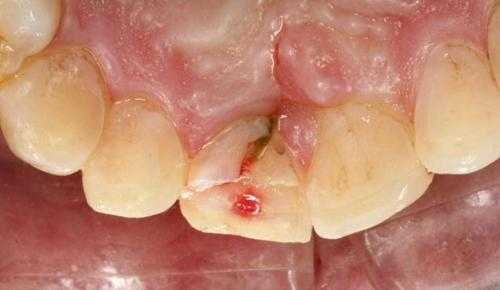 牙床骨折修复过程（牙床骨折修复过程图片）-图1