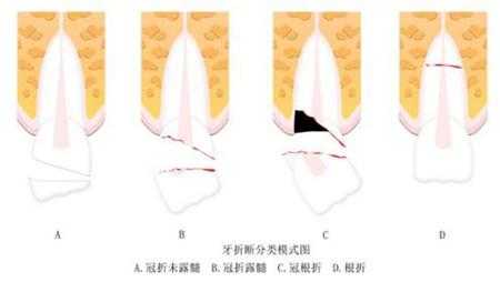 牙床骨折修复过程（牙床骨折修复过程图片）-图2
