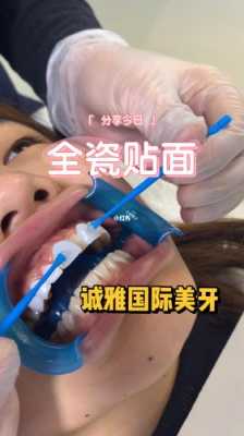 美牙的过程（美牙的步骤的视频教程）-图2