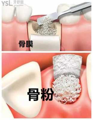 牙打骨粉过程（牙齿骨粉填充多久愈合好）-图3