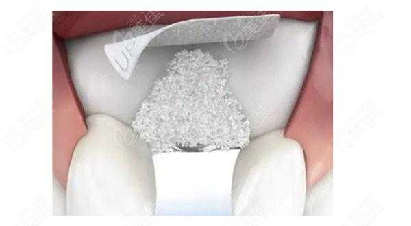 牙打骨粉过程（牙齿骨粉填充多久愈合好）-图2