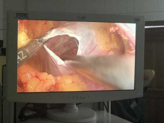 膀胱囊肿手术过程（膀胱囊肿开窗手术）-图1