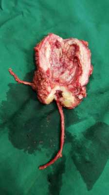 膀胱囊肿手术过程（膀胱囊肿开窗手术）-图2
