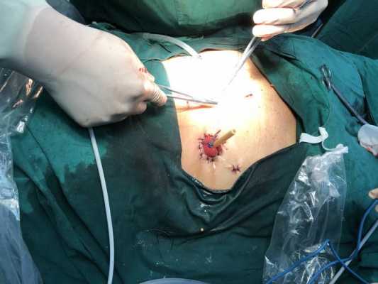 膀胱囊肿手术过程（膀胱囊肿开窗手术）-图3