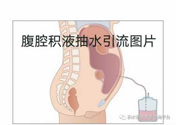 腹腔抽水过程（腹腔抽水不能超过多少）-图1