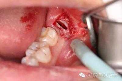 儿童拔牙过程（儿童拔牙技巧图解）-图3