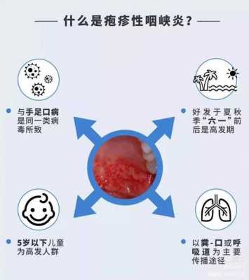咽峡炎过程（什么是咽峡炎）-图2