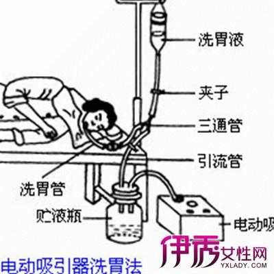 洗胃过程（洗胃过程中排出血性液体时护士应采取的措施是）-图3