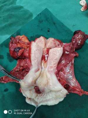 宫颈切除手术过程（宫颈切除术手术步骤）-图3