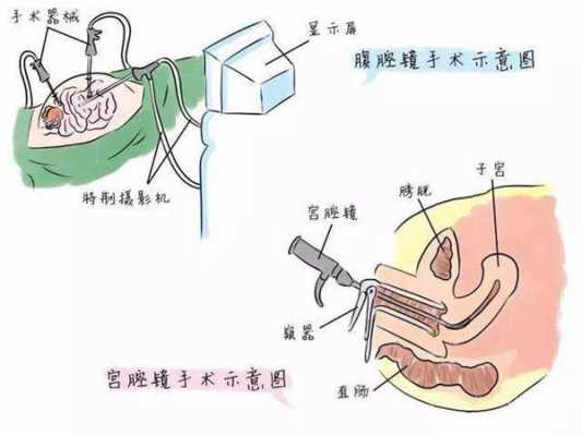 宫腔镜电切术过程（宫腔镜电切操作步骤）-图3