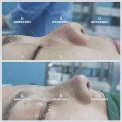 鼻综合恢复过程（鼻综合整形手术恢复）-图1