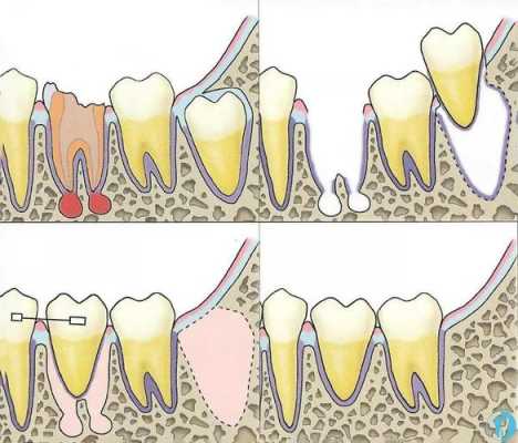 牙移植过程（牙移植术步骤）-图2