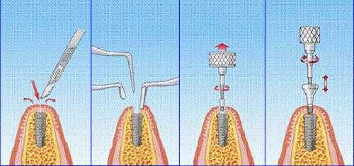 牙移植过程（牙移植术步骤）-图1