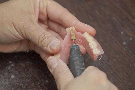假牙过程（树脂假牙制作过程）-图3