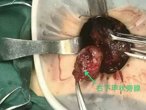 甲状腺手术视频过程（甲状腺手术视频过程图片）-图3