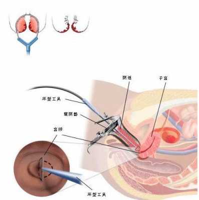 leep刀切息肉过程（leep息肉切除术）-图2