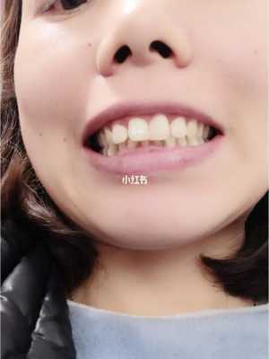 牙齿填充的过程（牙齿填充对牙齿好不好）-图1