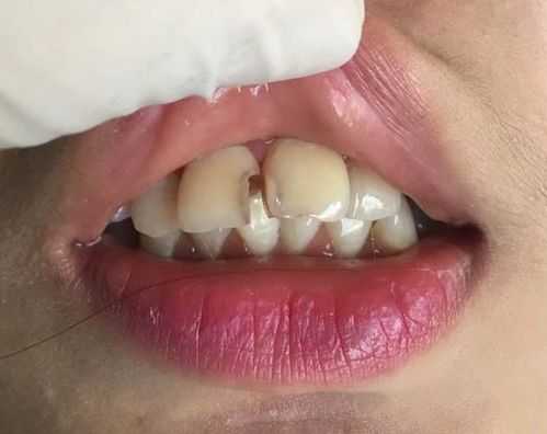 牙齿填充的过程（牙齿填充对牙齿好不好）-图2
