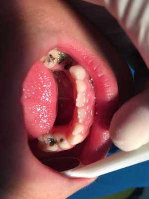 乳牙龋齿过程（乳牙龋齿是什么样子的图片）-图1