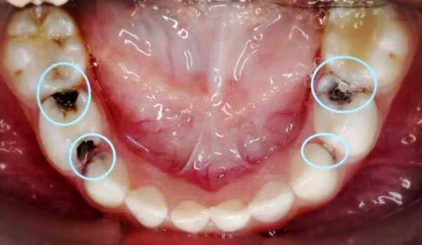 乳牙龋齿过程（乳牙龋齿是什么样子的图片）-图2