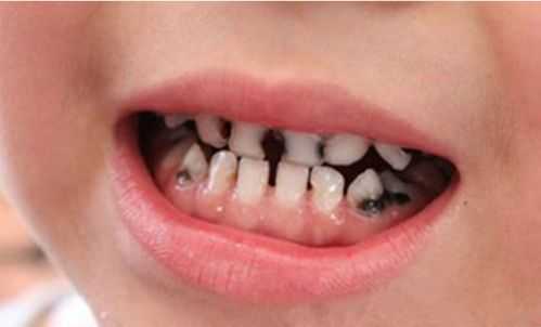 乳牙龋齿过程（乳牙龋齿是什么样子的图片）-图3