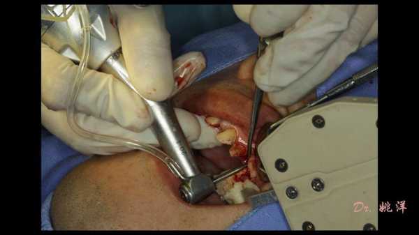上颌窦囊肿手术过程（上颌窦囊肿手术过程视频演示）-图2