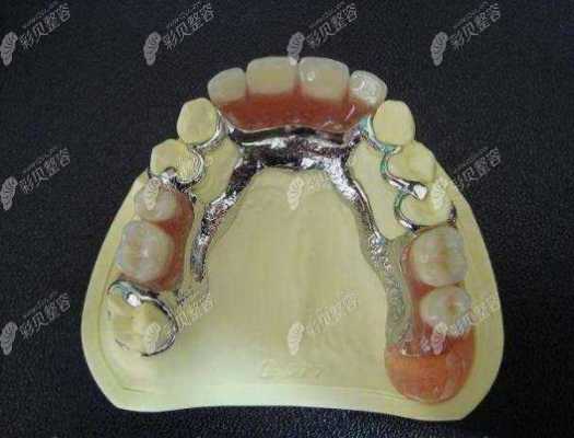 襄牙齿的过程（襄牙齿一般多少钱）-图3