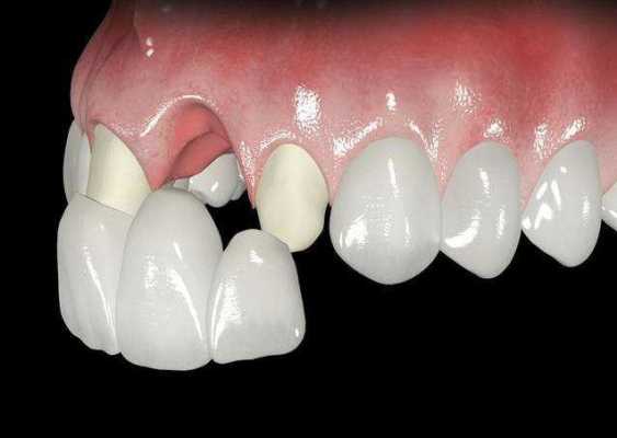 襄牙齿的过程（襄牙齿一般多少钱）-图2