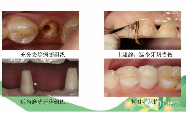 牙齿制备的过程（牙齿的制作流程）-图3