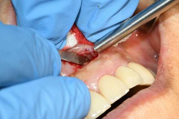 牙根尖刮治过程图（牙根尖搔刮术）-图1