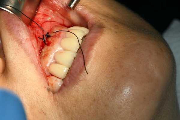 牙根尖刮治过程图（牙根尖搔刮术）-图2