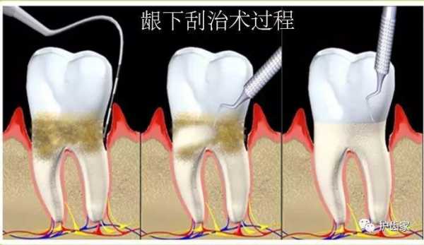 牙根尖刮治过程图（牙根尖搔刮术）-图3