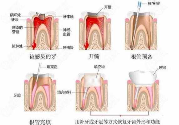 死髓牙根管治疗过程（死髓牙的根管治疗）-图1