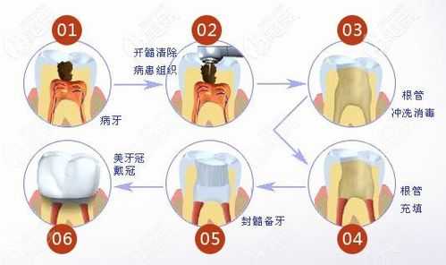 死髓牙根管治疗过程（死髓牙的根管治疗）-图2