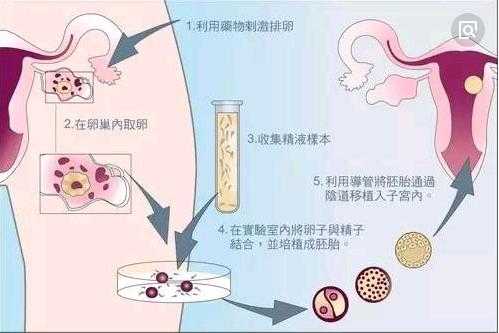 人工受精移植过程（人工受精胚胎植入过程）-图2