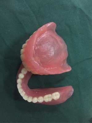 假牙抛光过程（假牙调磨处理）-图2