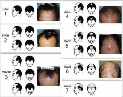 秃头的过程（秃头的概念）-图2