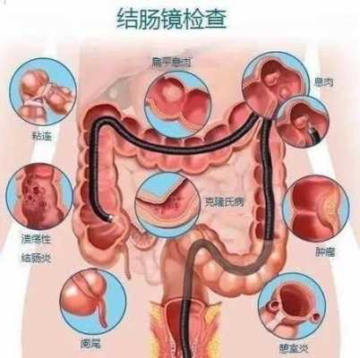 肠镜过程（无痛肠镜过程）-图1