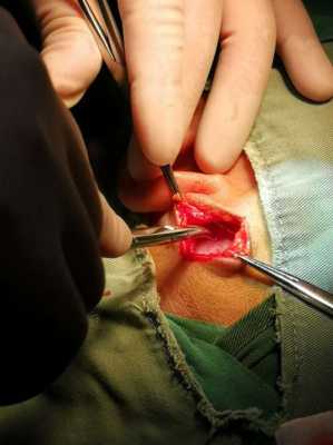 鼓膜手术过程（鼓膜手术过程视频）-图1