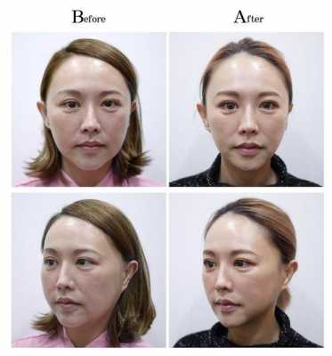 脸换皮的过程（脸换皮手术的成功率）-图2