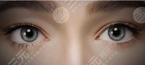 欧式双眼皮恢复过程图（欧式双眼皮有什么特点）-图1