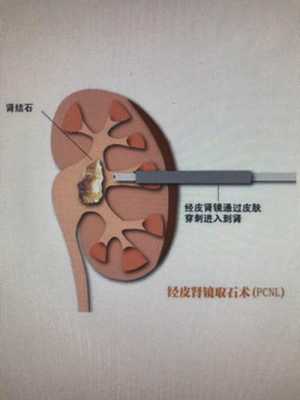 输尿管镜手术过程（输尿管镜手术过程中输尿管穿孔后如何处理好）-图3