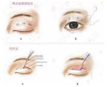 做双眼皮埋线过程（做双眼皮埋线过程视频教程）-图1