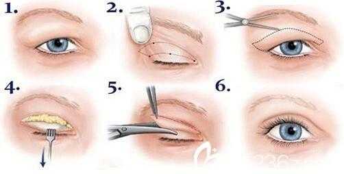 做双眼皮埋线过程（做双眼皮埋线过程视频教程）-图2