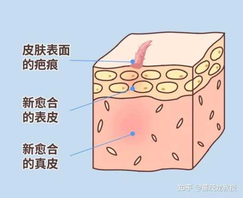 增生性疤痕消退过程（增生性疤痕消退过程动画）-图2