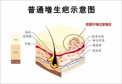 增生性疤痕消退过程（增生性疤痕消退过程动画）-图3