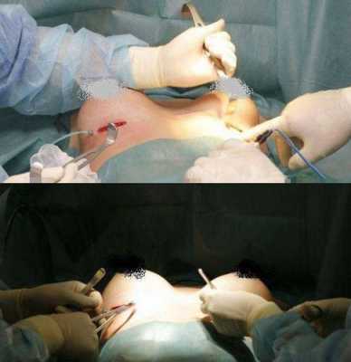 女性隆胸手术过程视频（女士隆胸手术）-图1