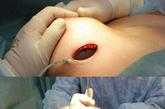女性隆胸手术过程视频（女士隆胸手术）-图2