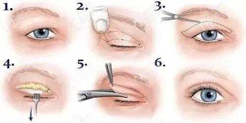 全切双眼皮手术过程图（全切双眼皮手术步骤）-图1